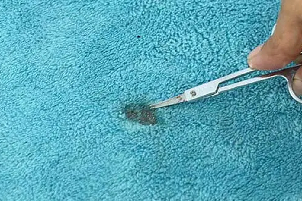 Sigara Yanığı Çıkarma